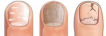 Zmiany w paznokciu